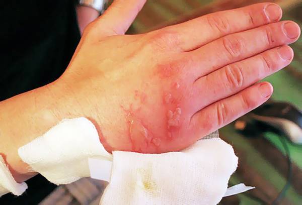 Brûlure chimique à portée de main