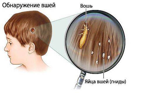 les poux dans les cheveux