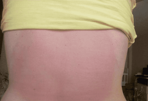 brûler sur la peau à partir de l'onguent finalgon