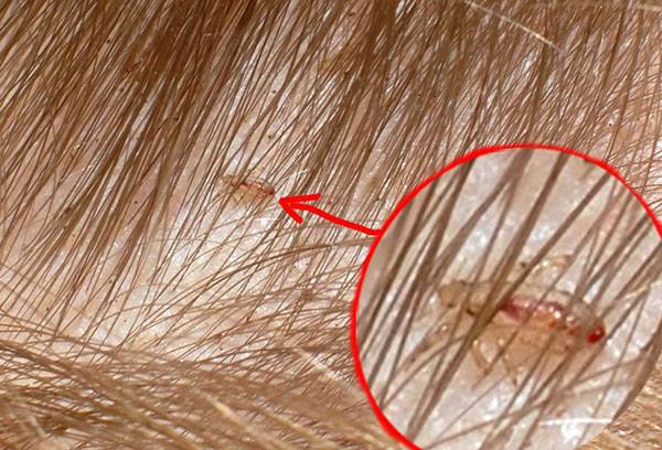 Poux dans les cheveux