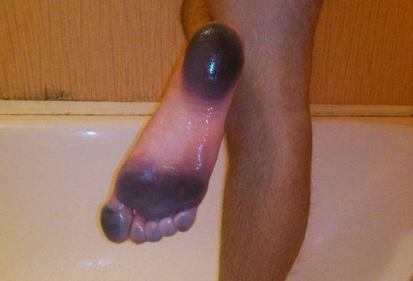 Pied taché avec des chaussures