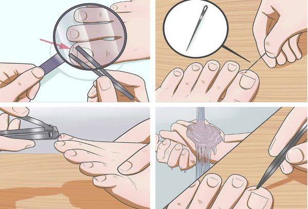 Enlèvement de l'éclat