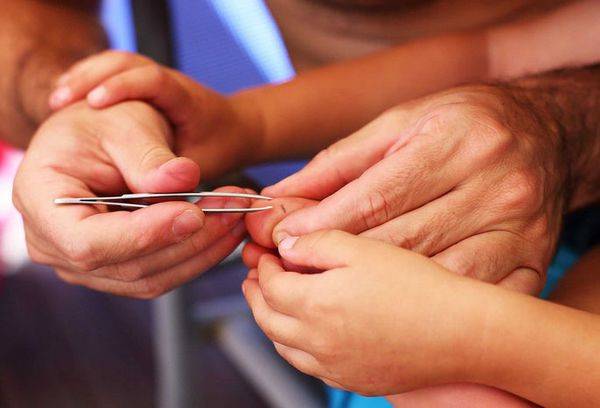 Extraction de pincettes par pincettes