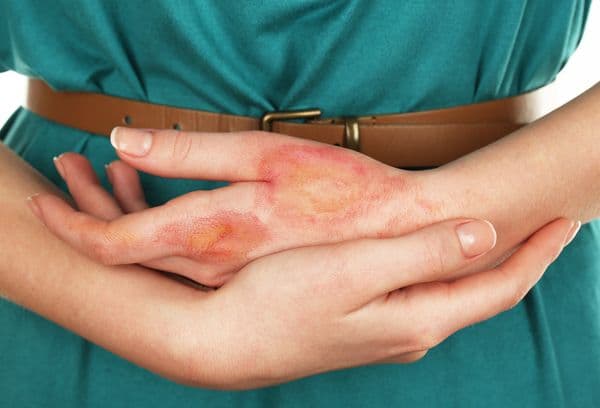 Brûlures par rayonnement