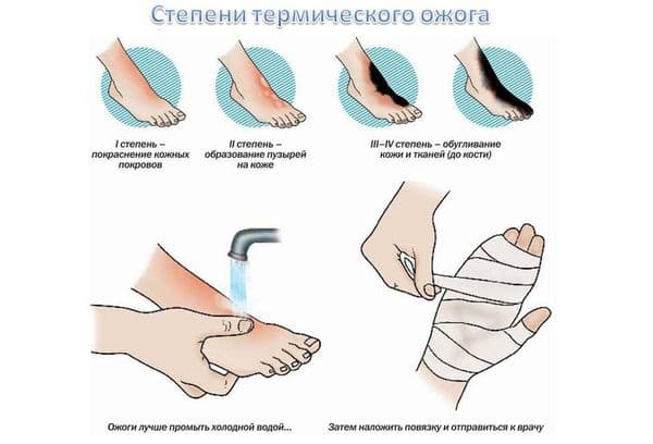 Degrés de brûlure thermique